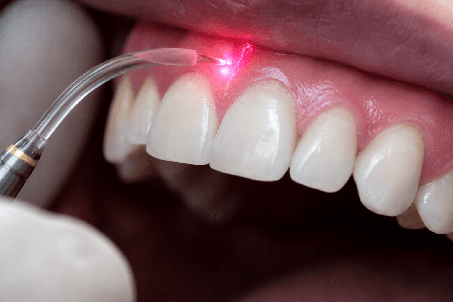 Close-up of laser technology used for gum treatment and soft tissue dental care. 