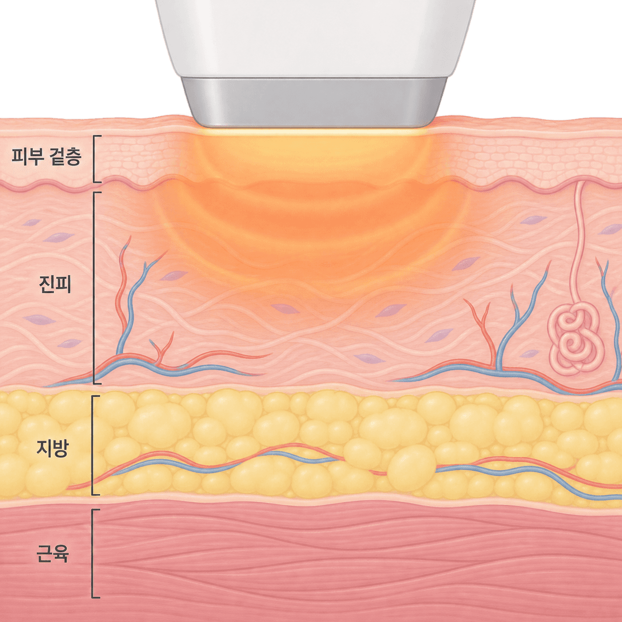 써마지는 피부에 닿는 팁을 통해 진피를 넓게 데워요