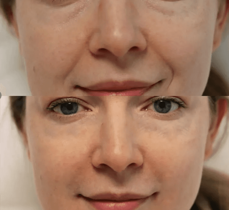 how long facial fillers usually last