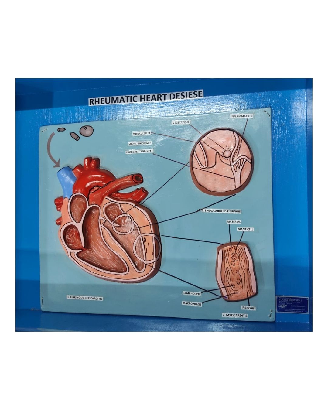 Rheumatic Heart Disease