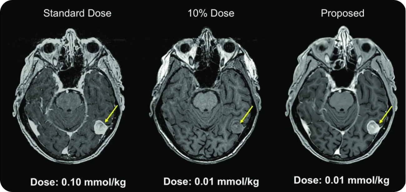 Example of low-dose contrast-enhanced MRI