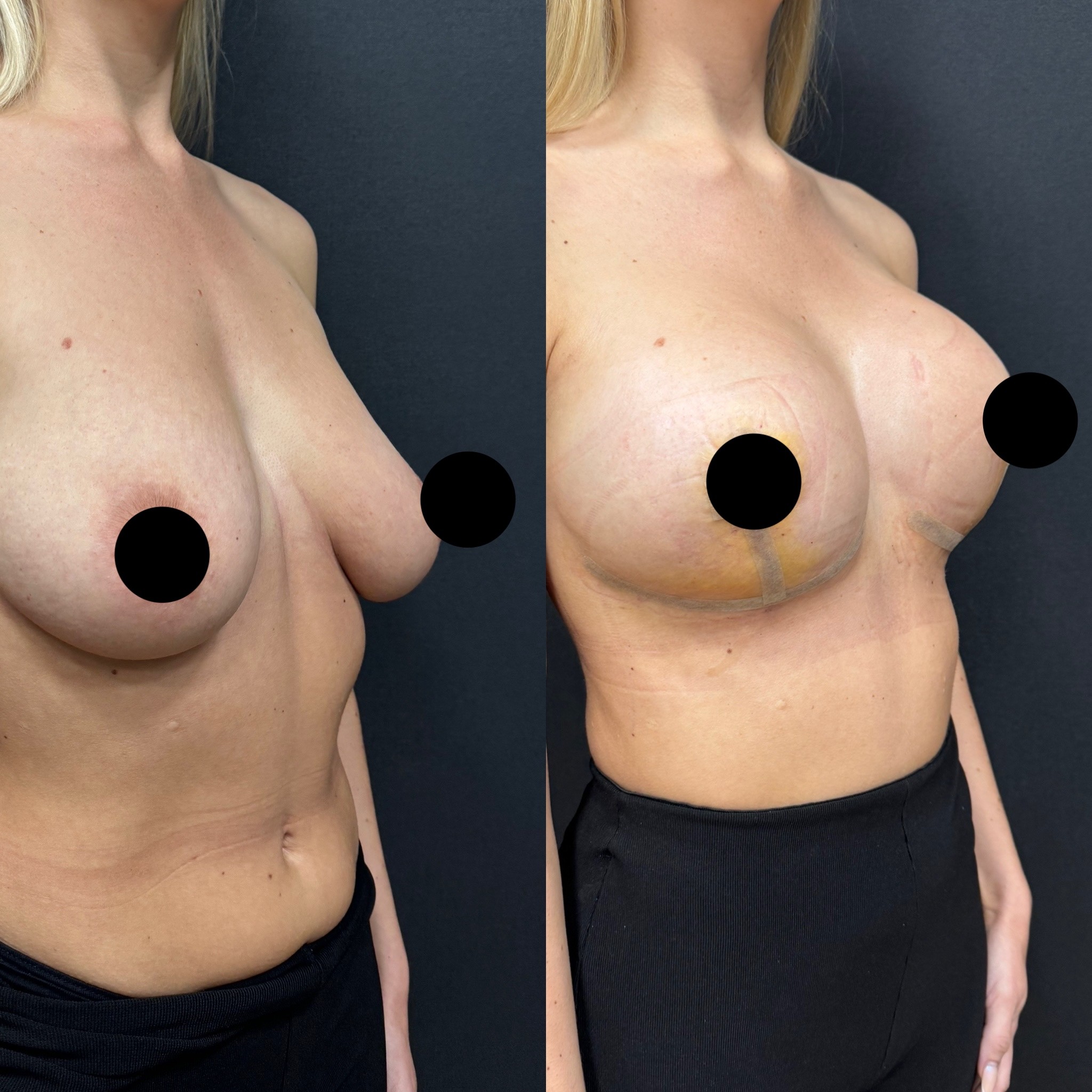 breast lift with implant before after 5 days result oblique view