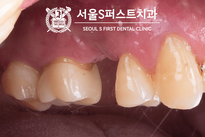 발치 후 1주일 후 사진