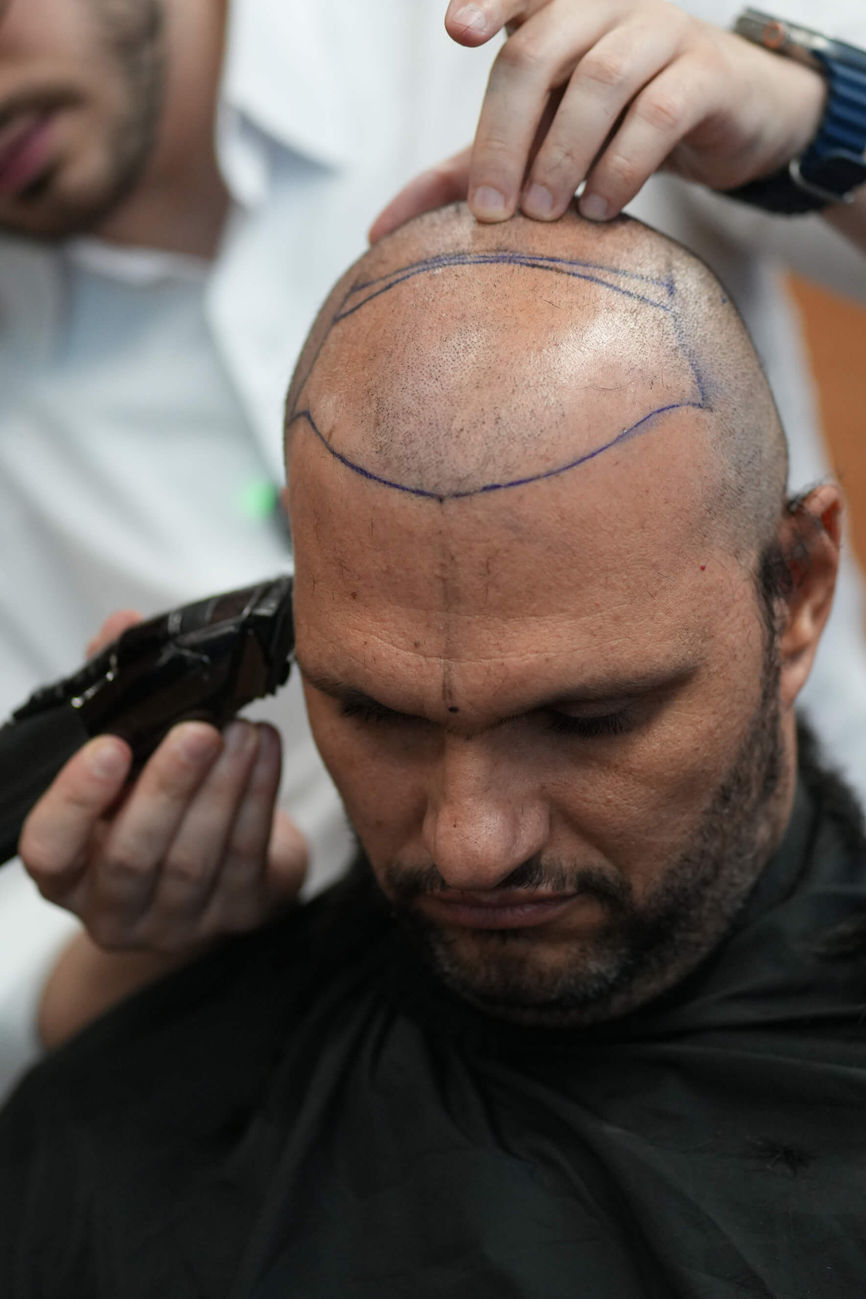 Homem com marcações de caneta na sua cabeça, se preparando para fazer um transplante capilar com o Dr. Hélio Accioly.