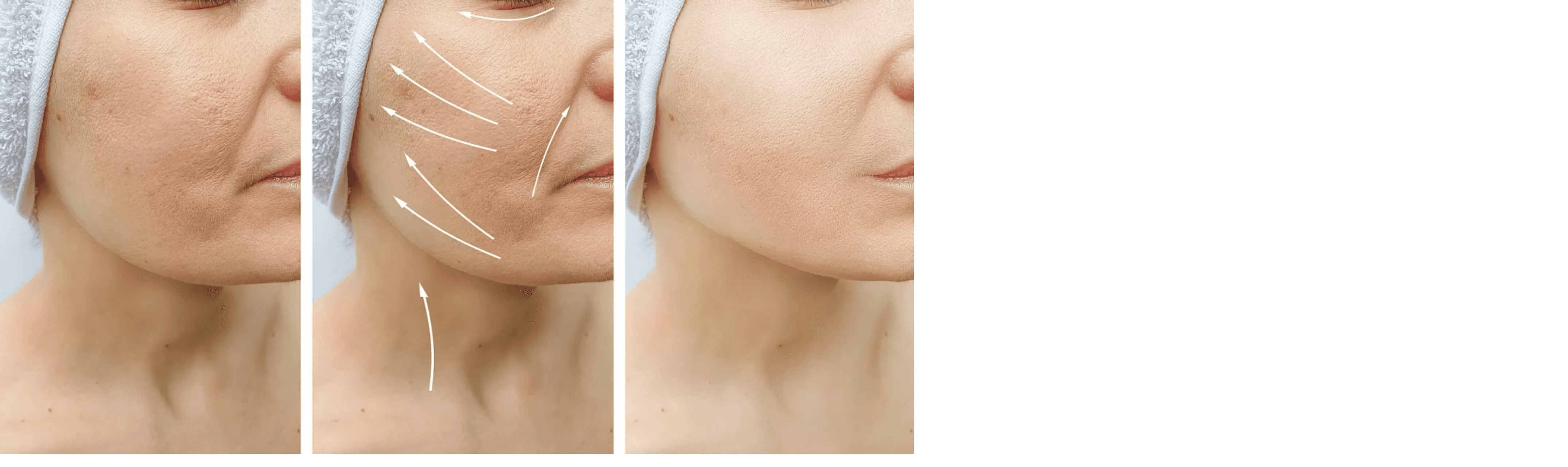 Before and After Comparison of Rveiling® PLLA-PEG Diluted Solution Injection Implant 8 Weeks Post-Treatment
