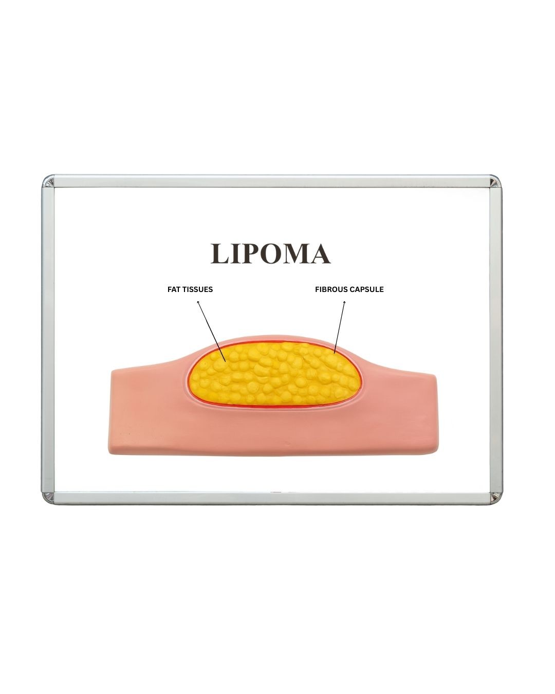 Lipoma 