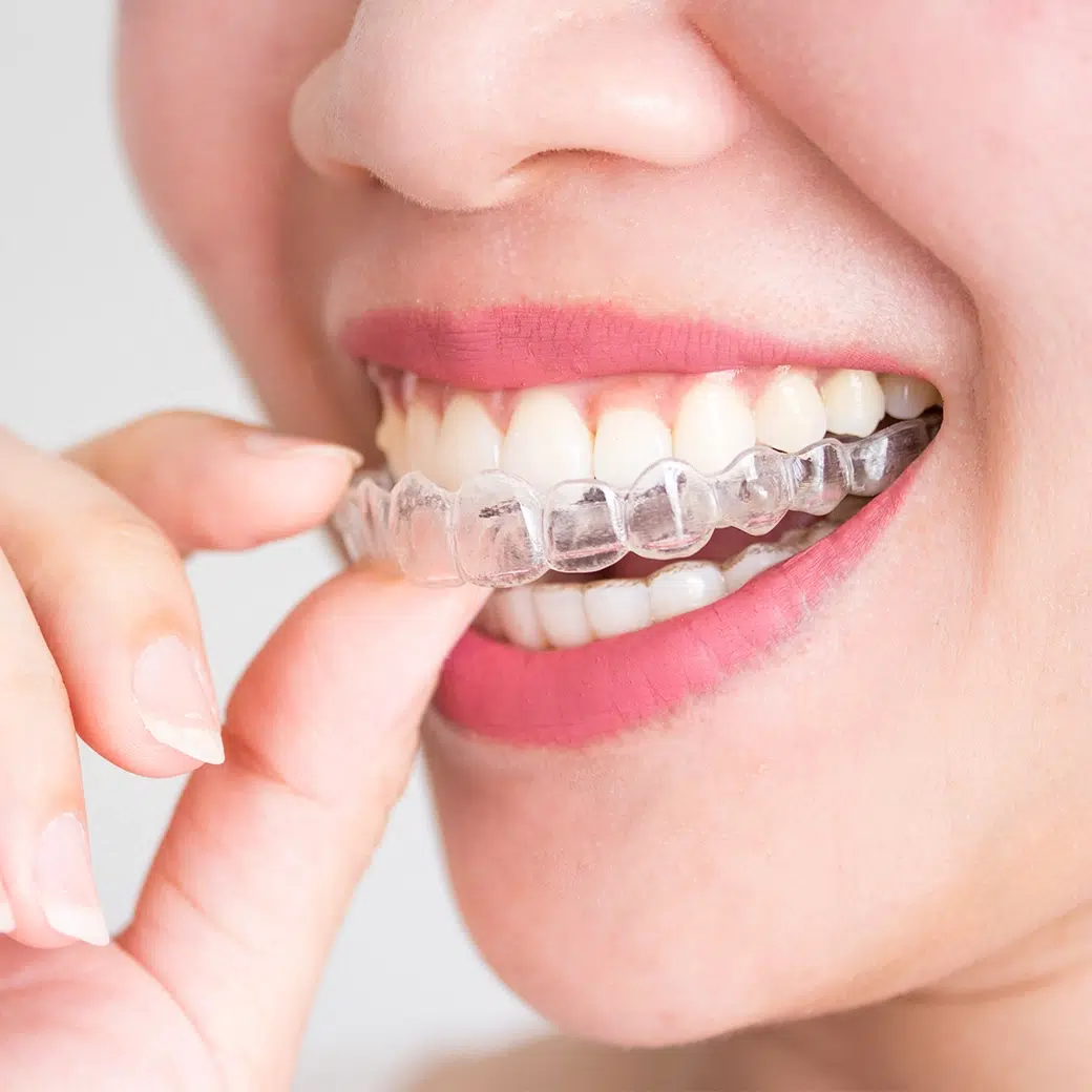 Invisalign Clear Aligners cosmetic dentistry treatment at Cosdent Bangkok cover image cosdent smile design
