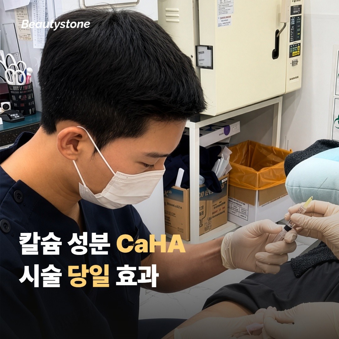 CaHA, 칼슘 성분으로 만드는 즉각 볼륨