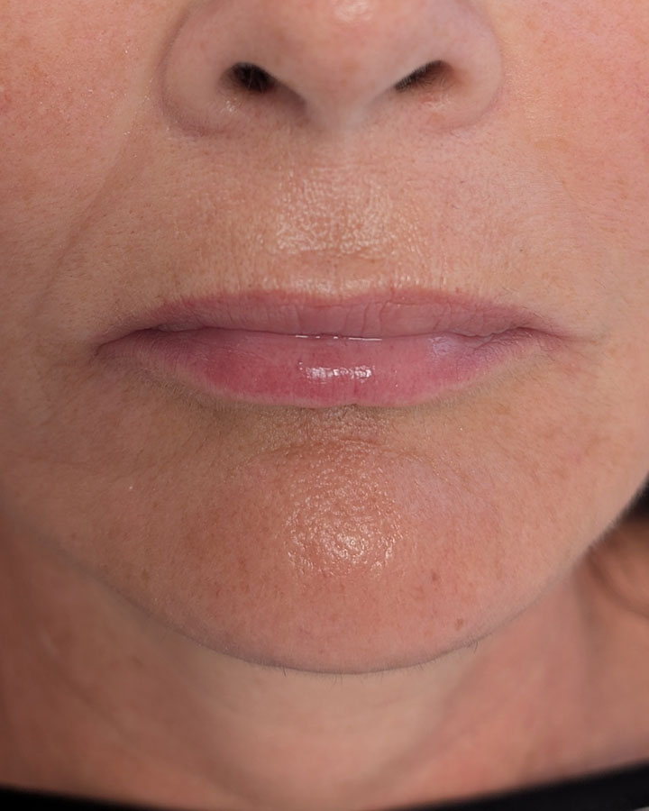 Fajčiarske vrásky nad hornou perou a strata objemu pred kombinovaným zákrokom