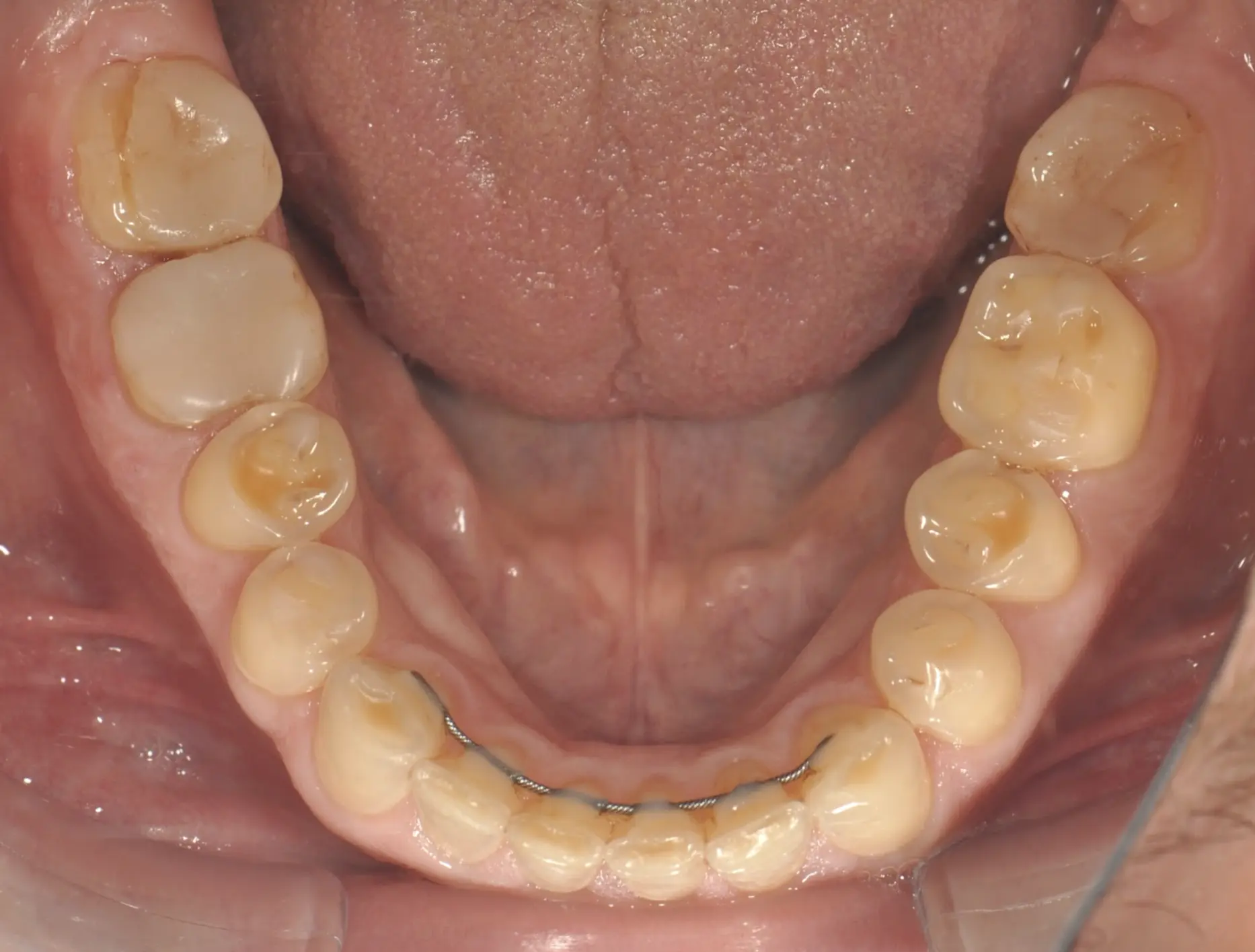 Pathological attrition (dental wearing) due to a dysfunctional bruxism