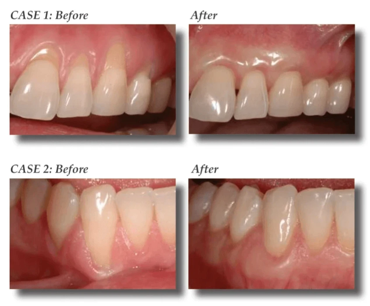 Connective Tissue Grafting [ie Periodontal Plastic Surgery] | Bloor-Yorkville Periodontics