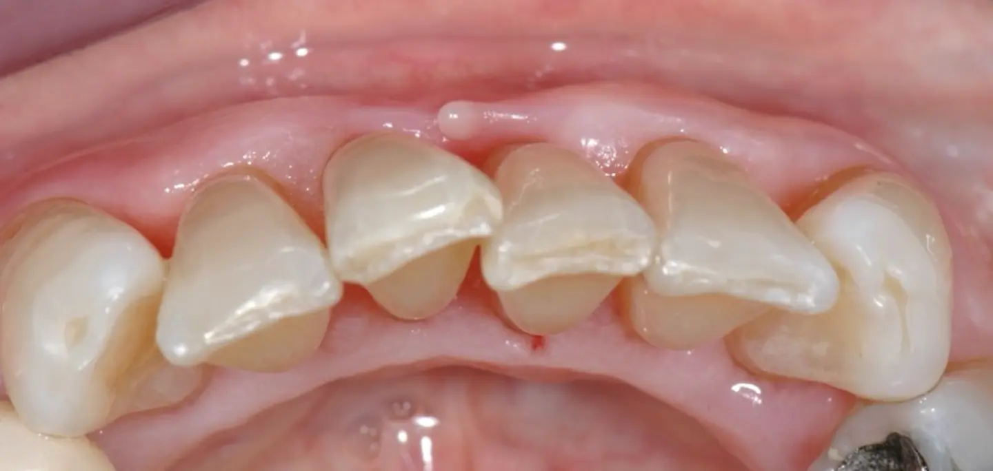 Gingivitis. Entwicklung des Zahnfleisches vor und nach der Behandlung