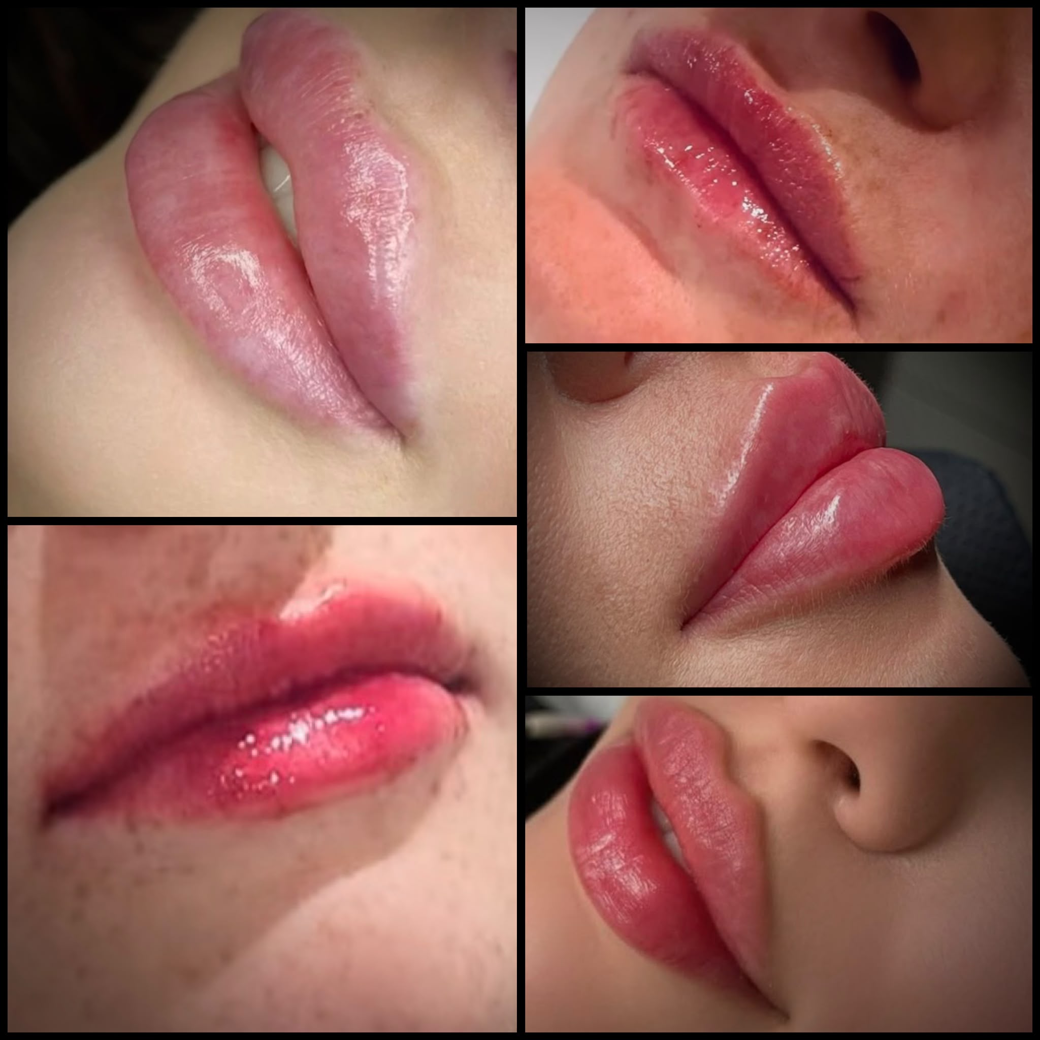 Lip Filler Treatment Being Performed
