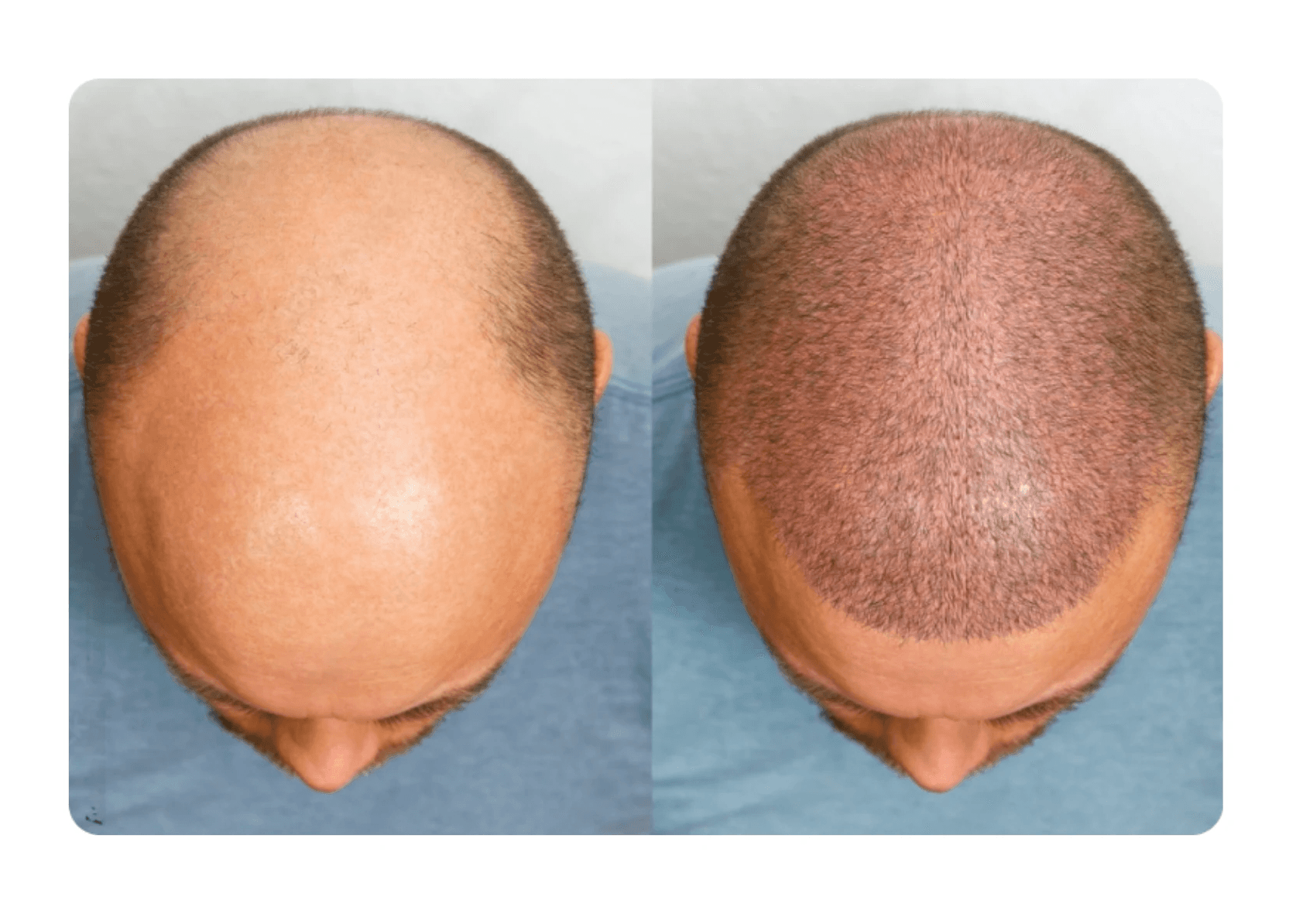 Hero Page Image for assesment of baldness grade