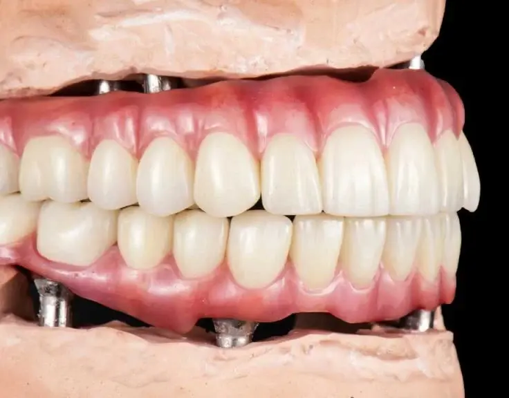 all-on-4 dental implants