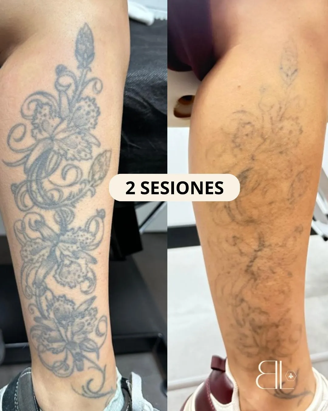 Reducir intensidad de tatuaje con láser en Móstoles