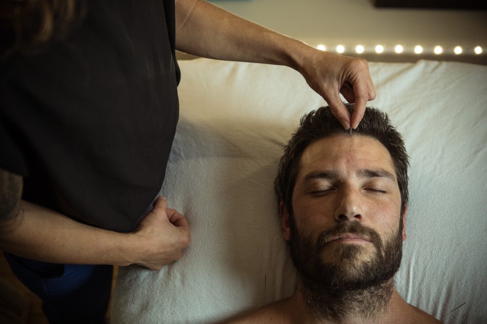 man recieving acupuncture