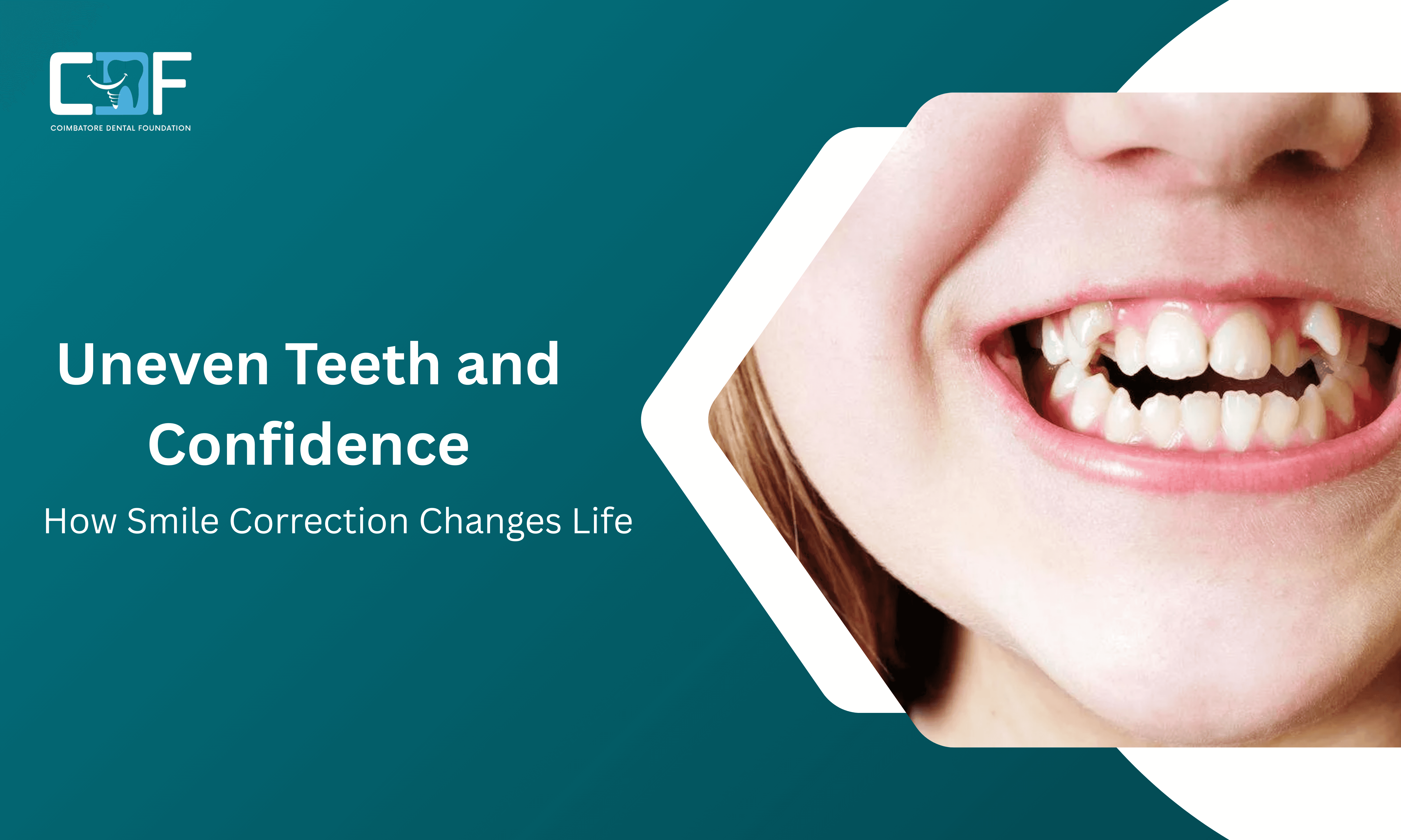 Uneven Teeth & Confidence: Smile Correction in Coimbatore