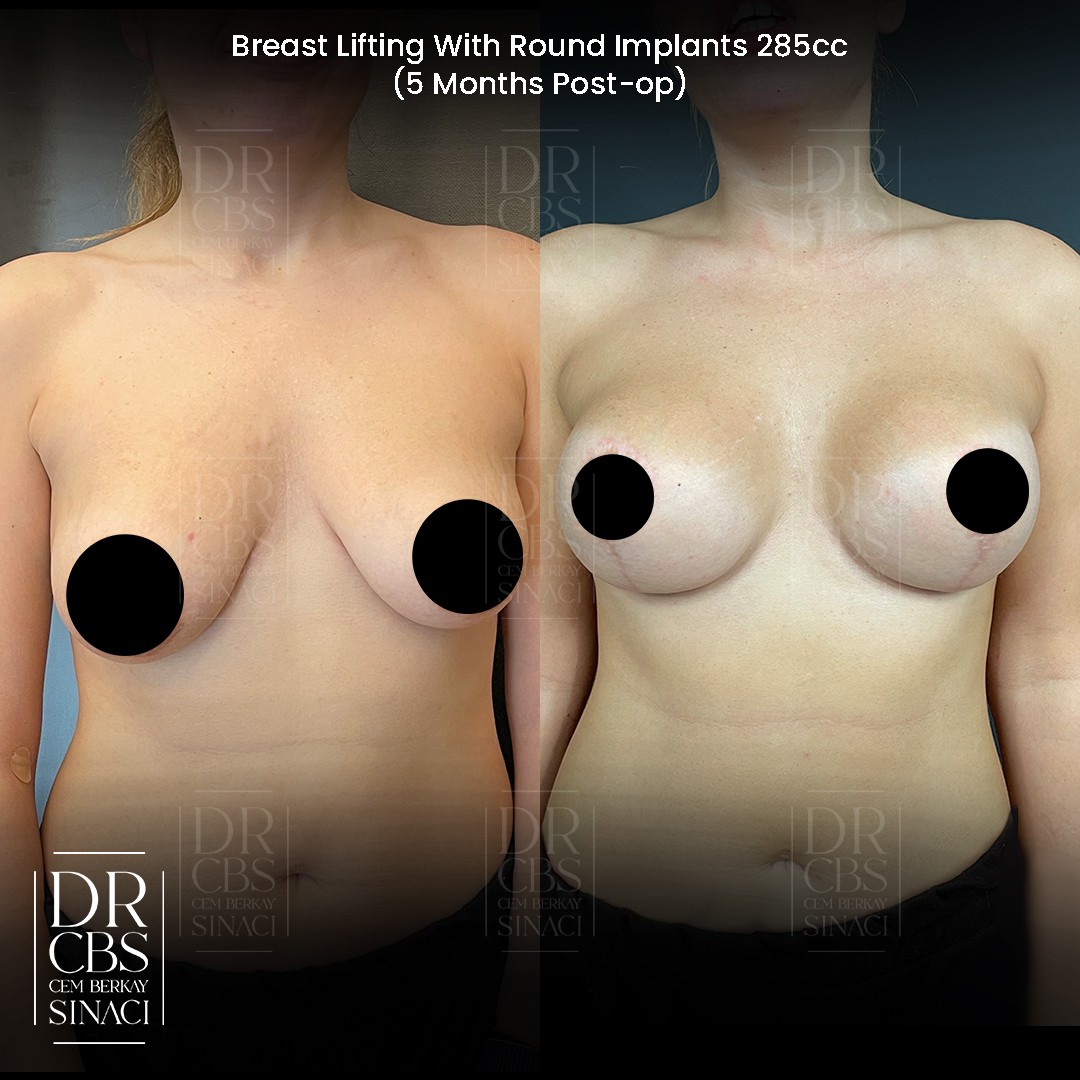 breast lift with implant 6 months before after front view