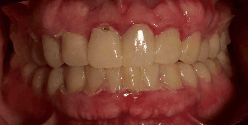 Digital mock-up tried in the patient's mouth