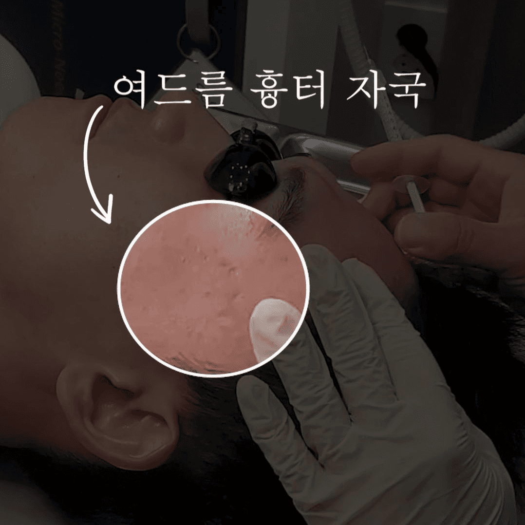 "짜기만 하면 낫는 줄 알았습니다" 홍대 피부과 의사가 말하는 여드름 치료의 진짜 순서