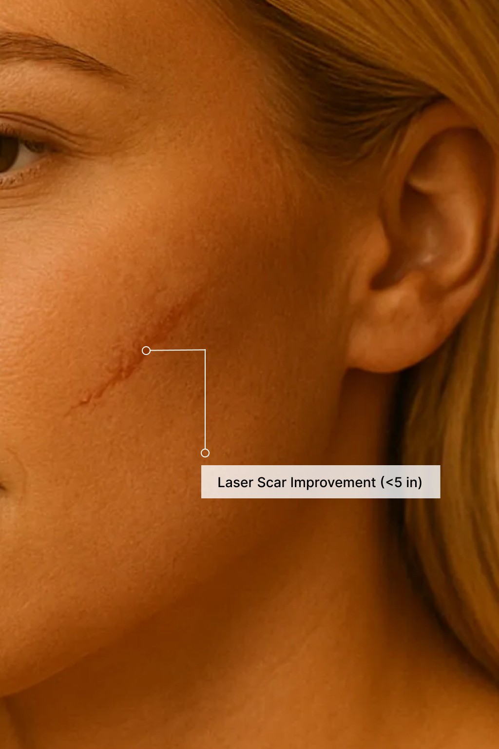 Close-up of a woman’s cheek showing a small facial scar highlighted for a laser scar-improvement treatment.