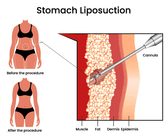 What Is “Liposculpture” (Body Contouring)? How Is It Different from Liposuction?
