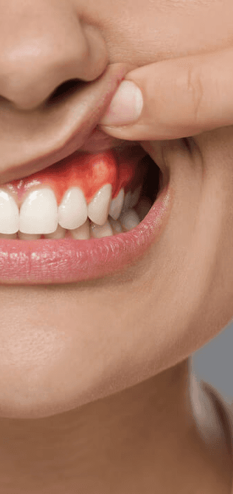 Gum Disease Treatment Rochelle Park
