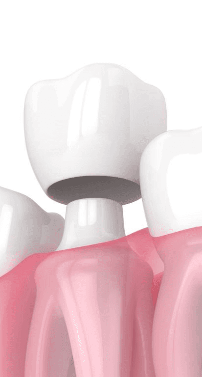 Same-Day Dental Crown Fort Lee