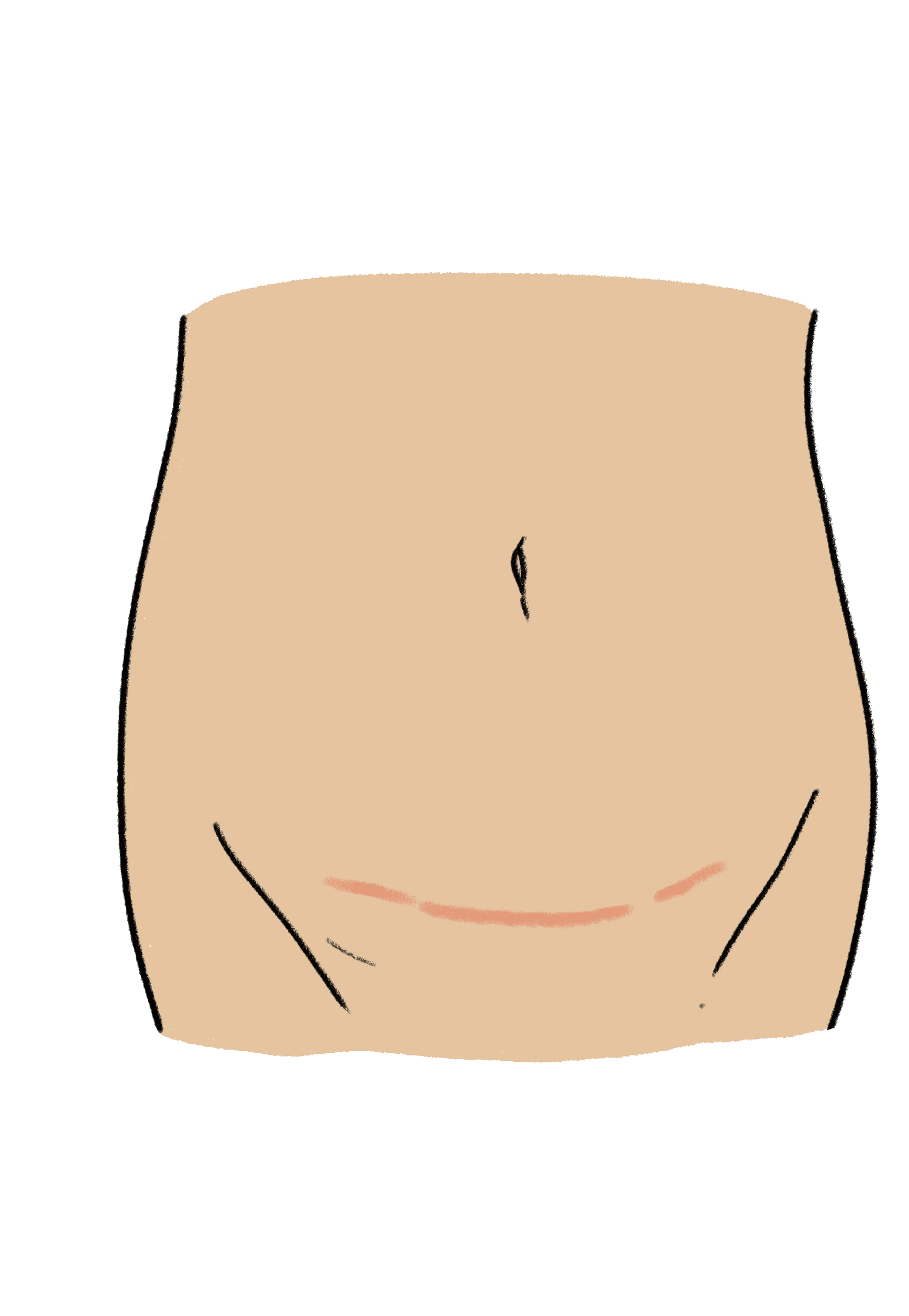 An illustration of a caesarean scar across the bikini line of the abdomen