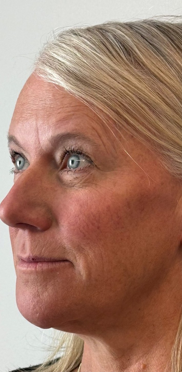 After: a woman with light hair in three-quarter view.