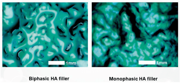 Monophasic vs Biphasic Fillers: Key Differences