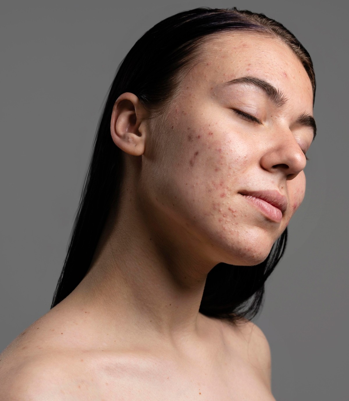 Young woman with mild to moderate acne on her cheeks and chin, eyes closed in a calm expression