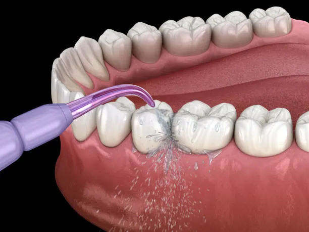Intraoral Cameras