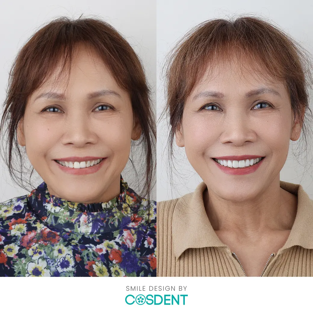 ป้อม3 เคสทำวีเนียร์ หมอวรรณ cosdent smile design