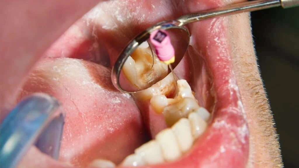 root canal