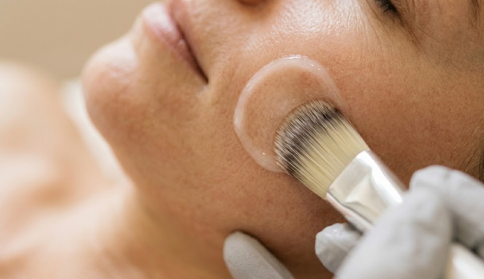 Professionele peeling bij Skin Boost Clinic in Rijswijk