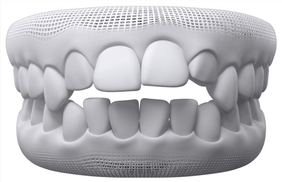 3D illustration showing upper and lower teeth with an anterior open bite condition