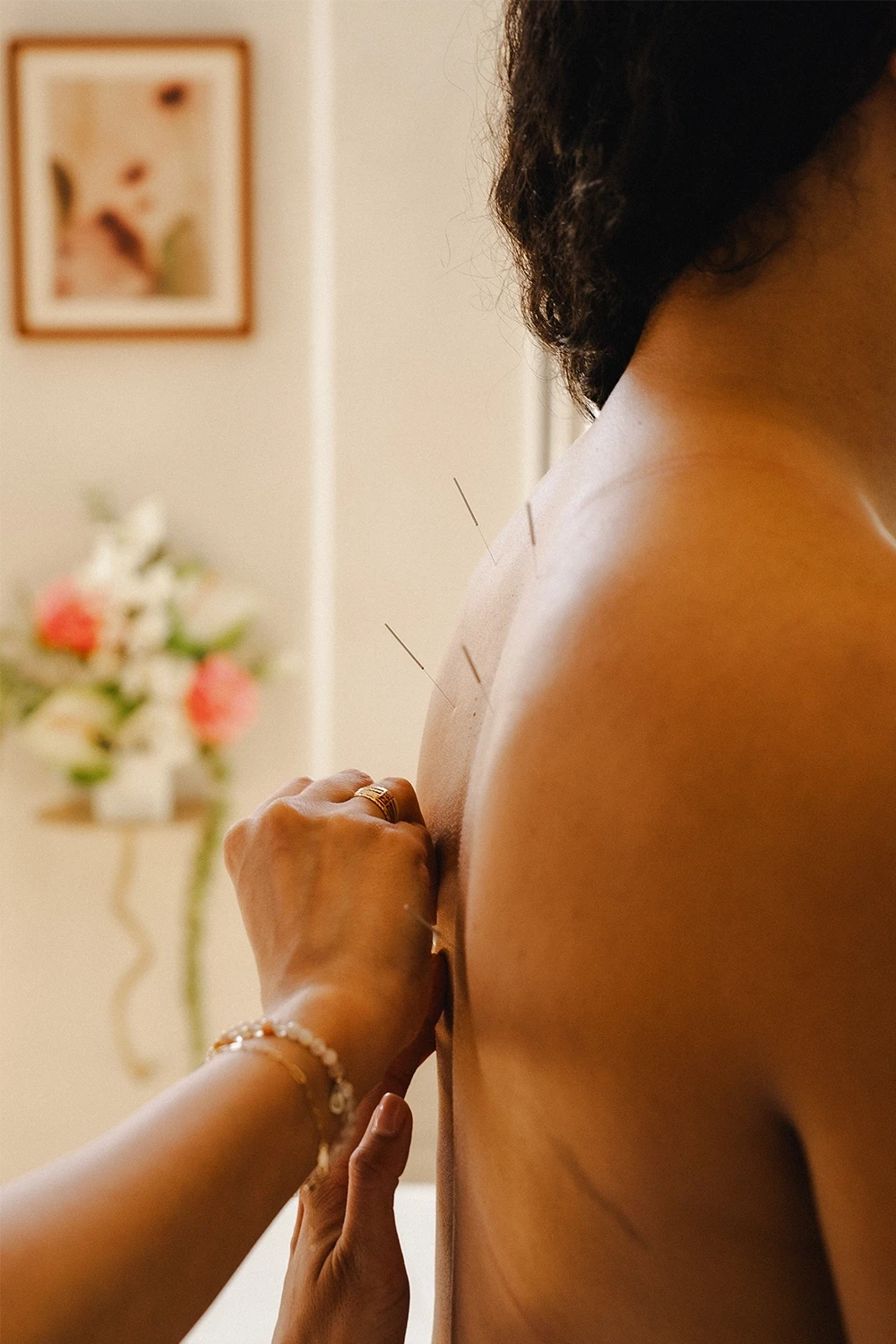 Woman receiving acupuncture