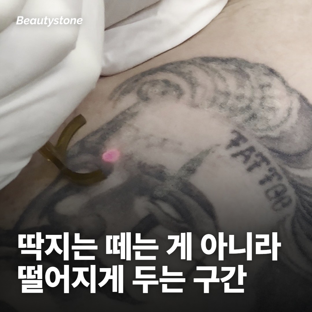 시술 당일 — 바르는 것과 씻는 것의 순서