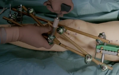 Knee spanning external fixation