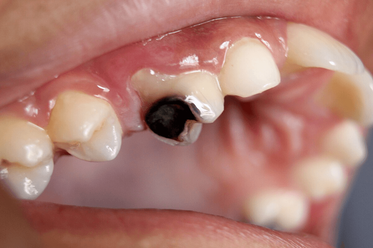 severe tooth decay
