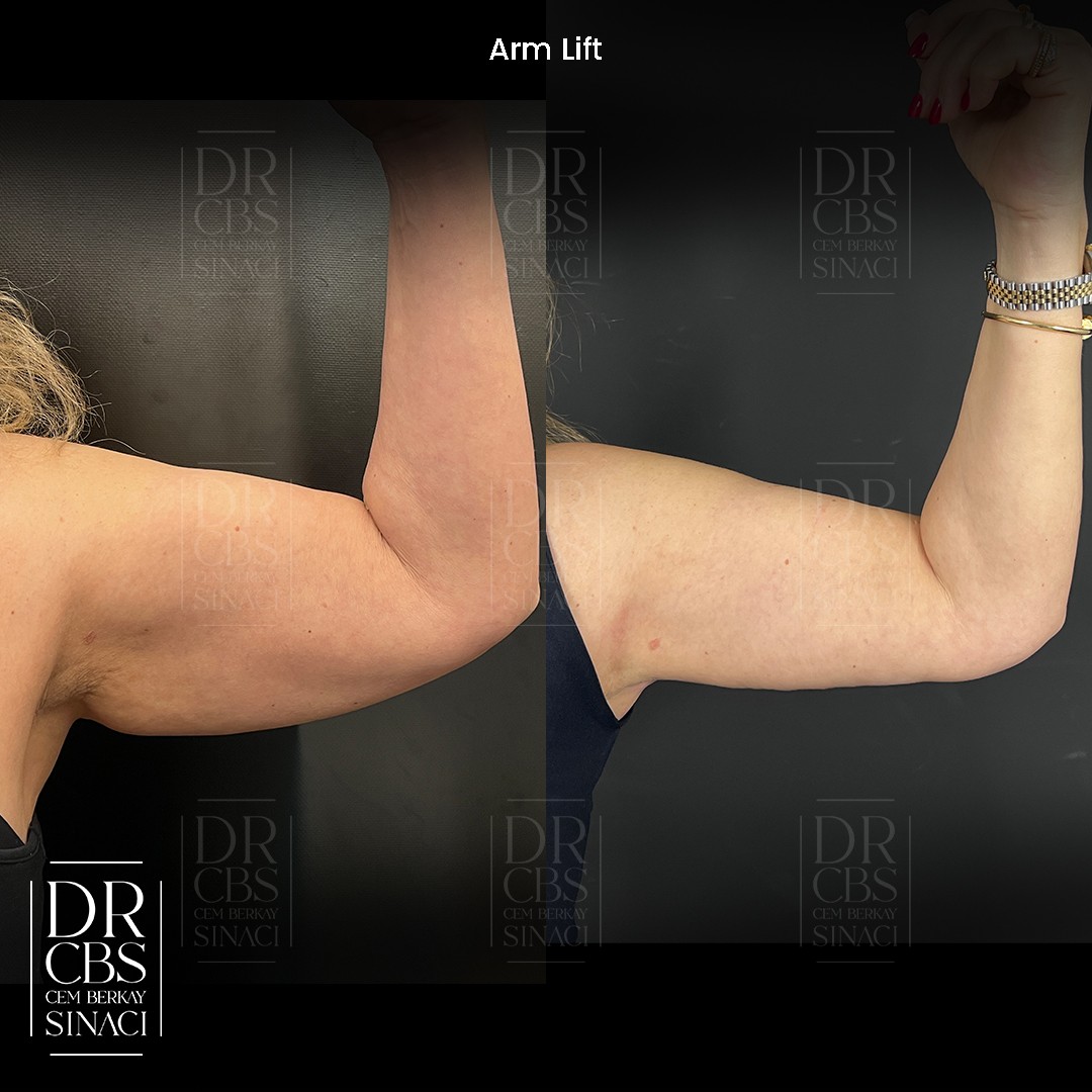 before after arm lift 2 months post-op left arm front view