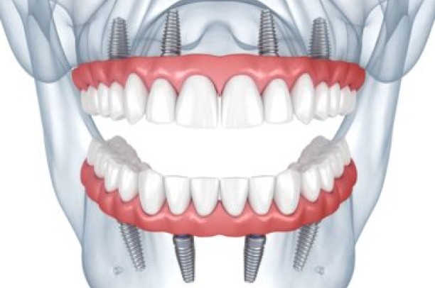 Implantes dentários/ Implantes zigomáticos/ Protocolo All on Four/ Dentes fixos sem enxerto ósseo em poucos dias - Dr Bruno Gomes Bucomaxilo