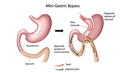 Mini Gastric Bypass | Dr Aloy Mukherjee