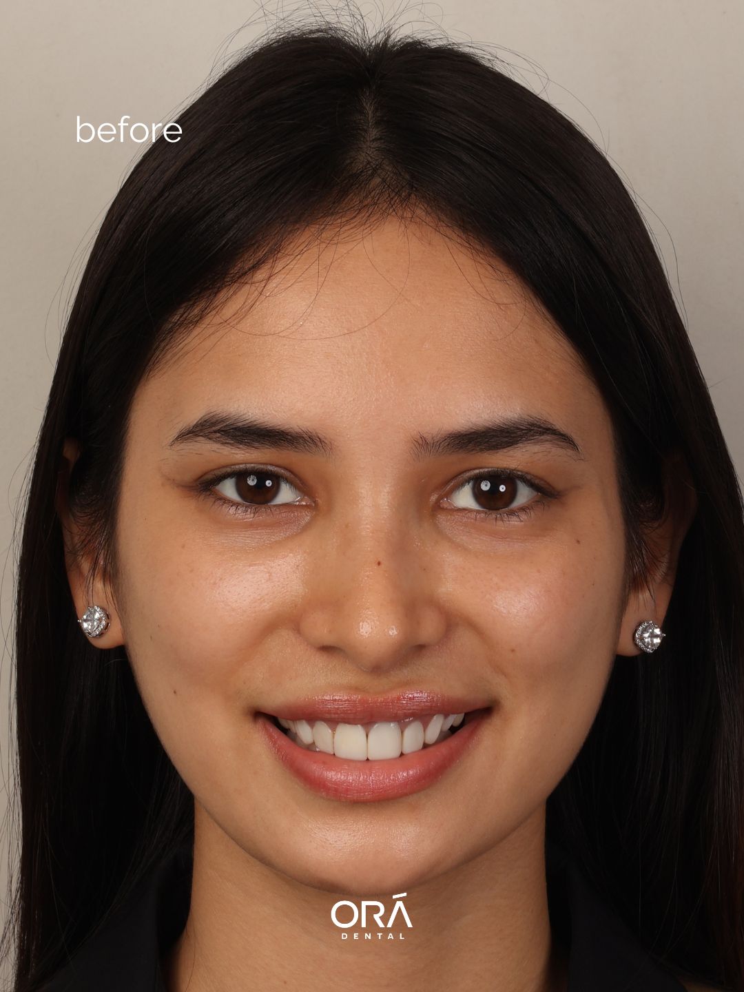 Before photo of Miss Universe Philippines 2025 Top 12 Finalist Juliana Fresado showing discolored composite veneers before smile redesign at Ora Dental Makati