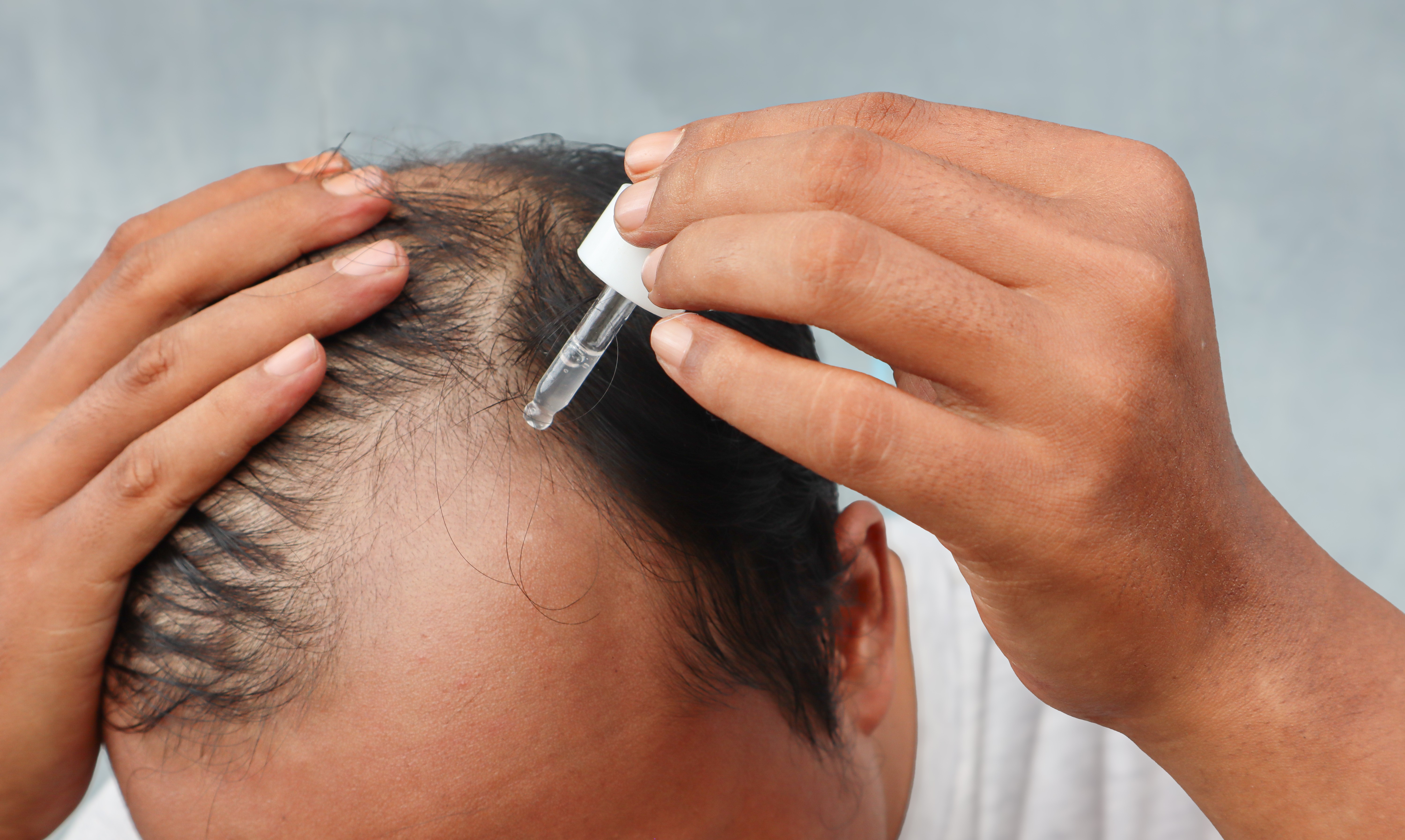 Hair + Me | What is Dutasteride?