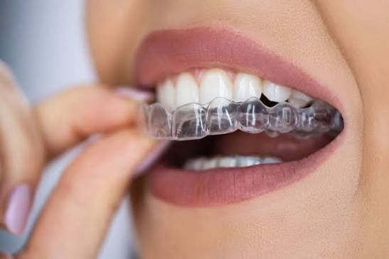 A model of a teeth with braces and braces