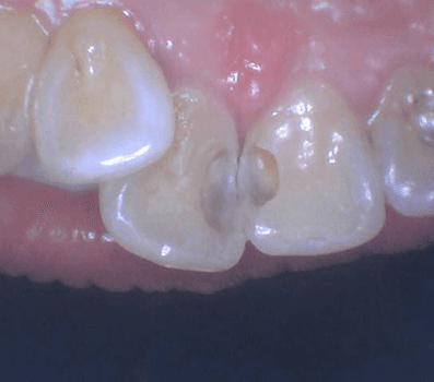 Tooth Colored Anterior Fillings - Before