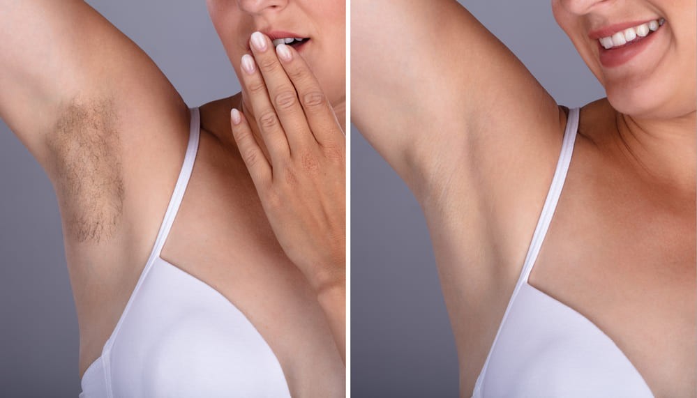 Underarm hair removal results before and after